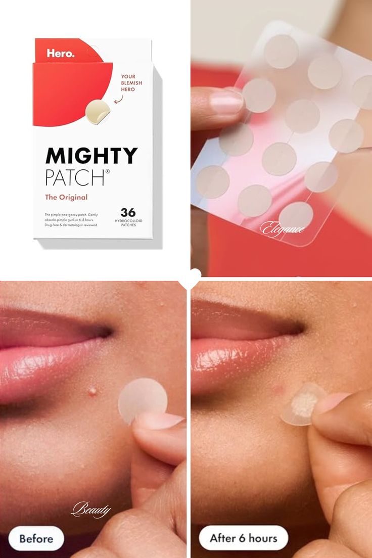 Acne patch